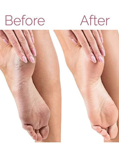 Electric Pedicure Foot File Callus Remover thumbnail 5